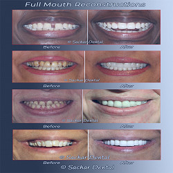 Dentist NYC | Top Prosthodontist NYC | Sachar Dental NYC